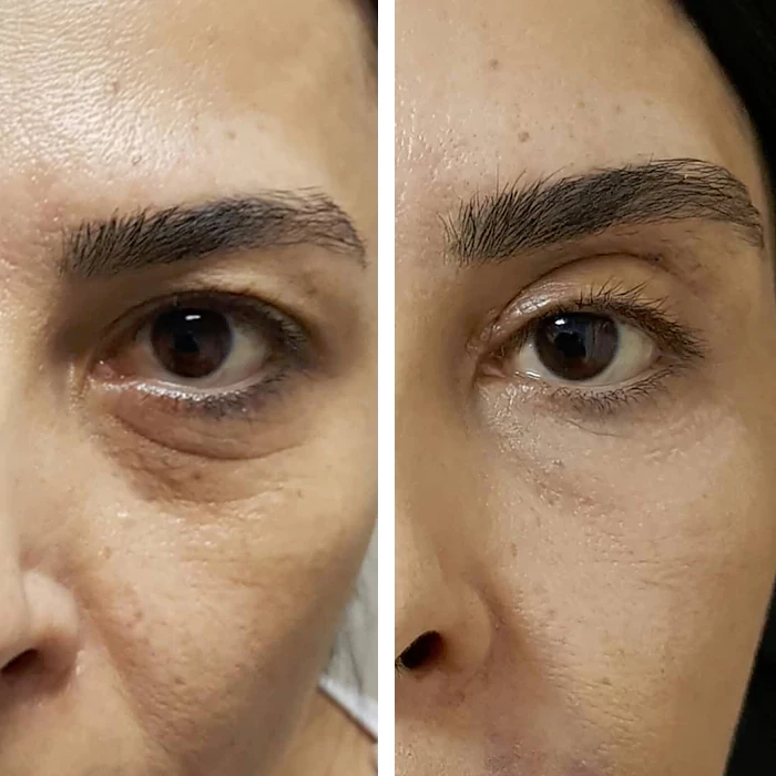 before & after photo of عملية تجميل الجفون