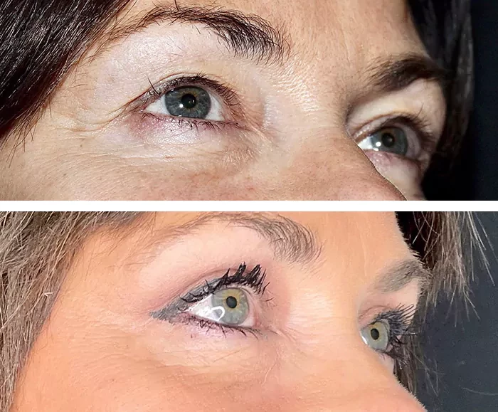before & after photo of Eyelid Surgery