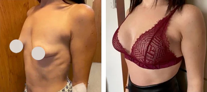 before & after photo of Breast Implants