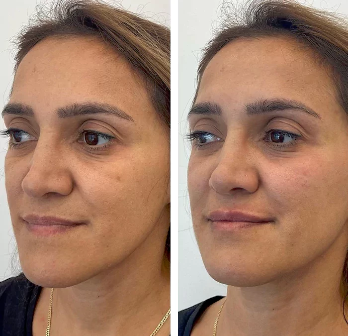 before & after photo of cheek-filler