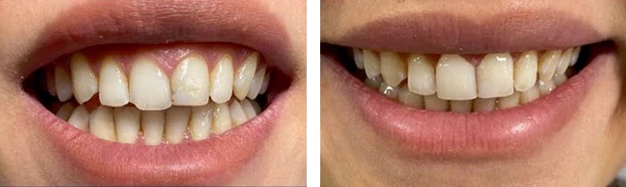 before & after photo of Dental Crown