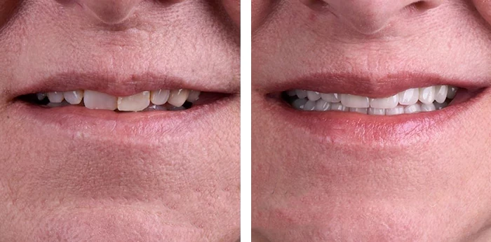 before & after photo of Dental Crown