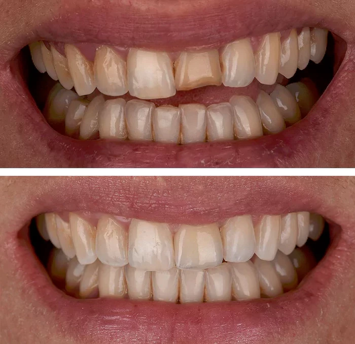 before & after photo of Dental Crown