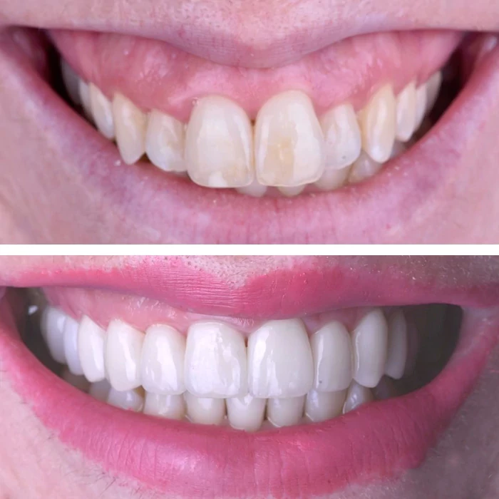 before & after photo of Dental Crown