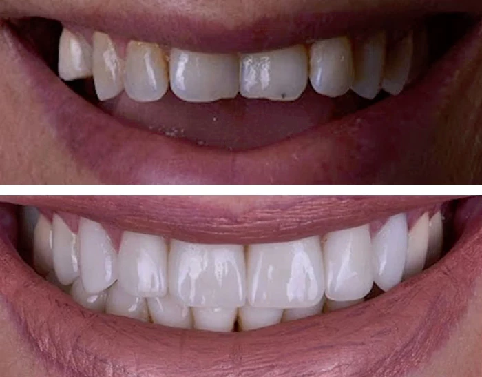 before & after photo of Dental Crown