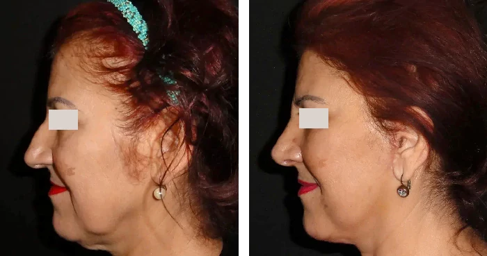 before & after photo of Facelift
