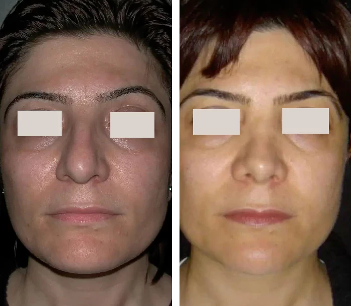 before & after photo of Facial Fat Transfer