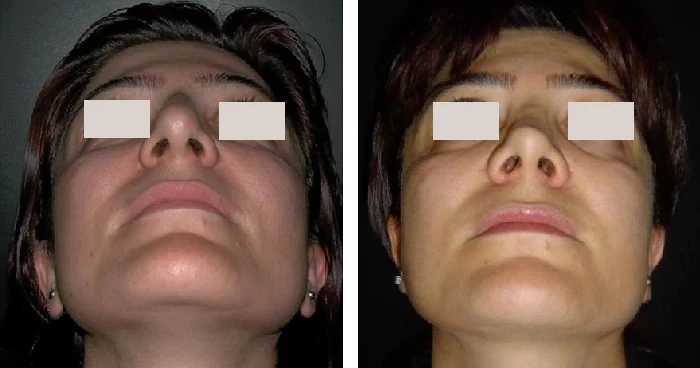 before & after photo of Facial Fat Transfer