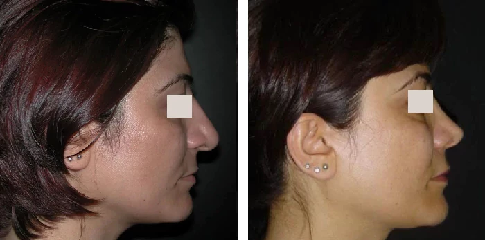 before & after photo of Facial Fat Transfer