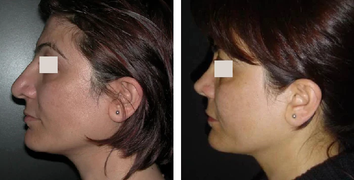 before & after photo of Facial Fat Transfer