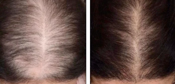 before & after photo of الميزوثيرابي