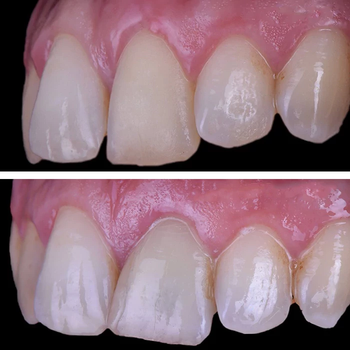 before & after photo of Dental Implant