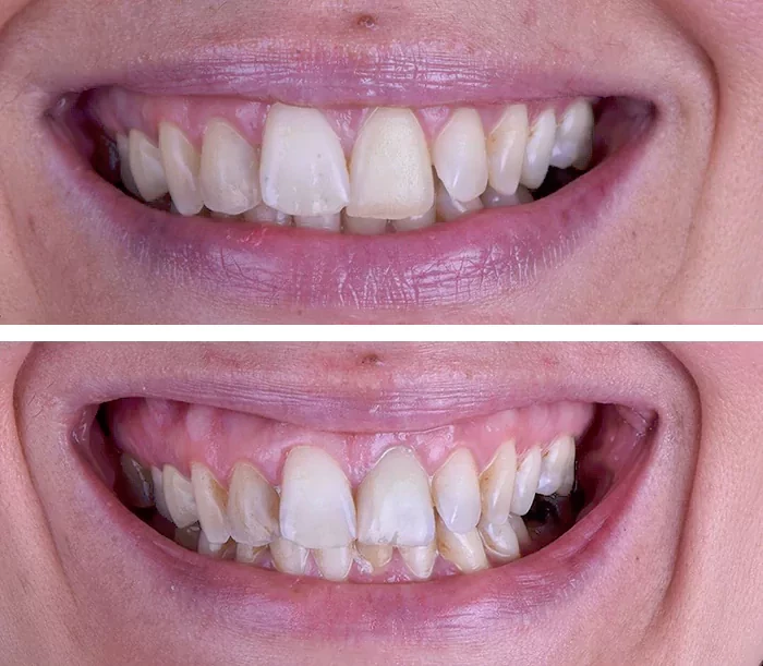 before & after photo of Dental Implant