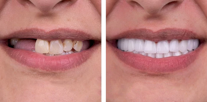 before & after photo of Dental Implant