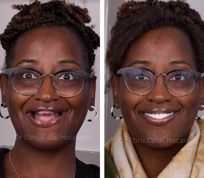 before & after photo of Dental Implant