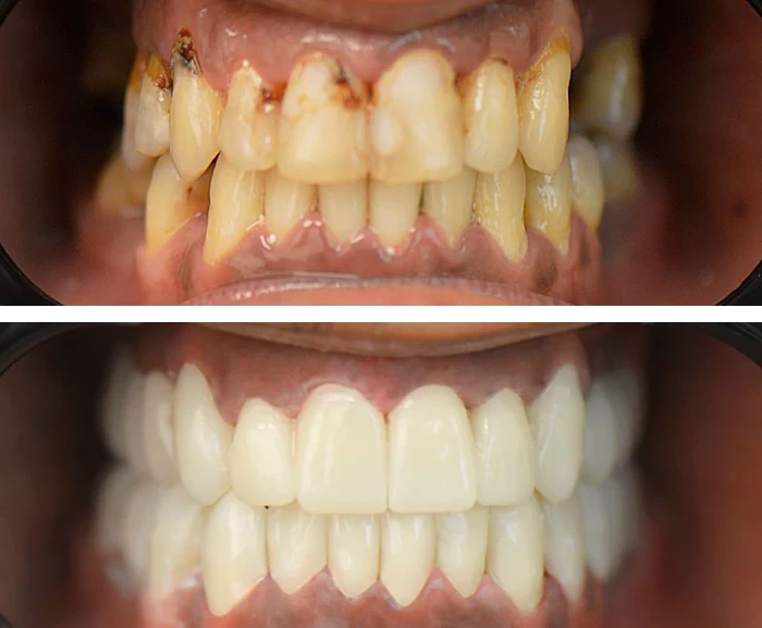 before & after photo of زراعة الأسنان