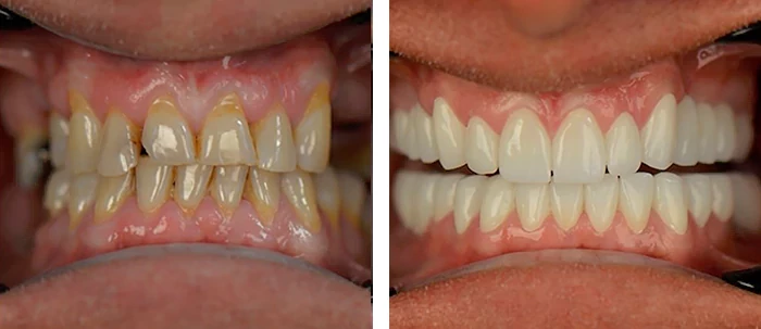 before & after photo of زراعة الأسنان