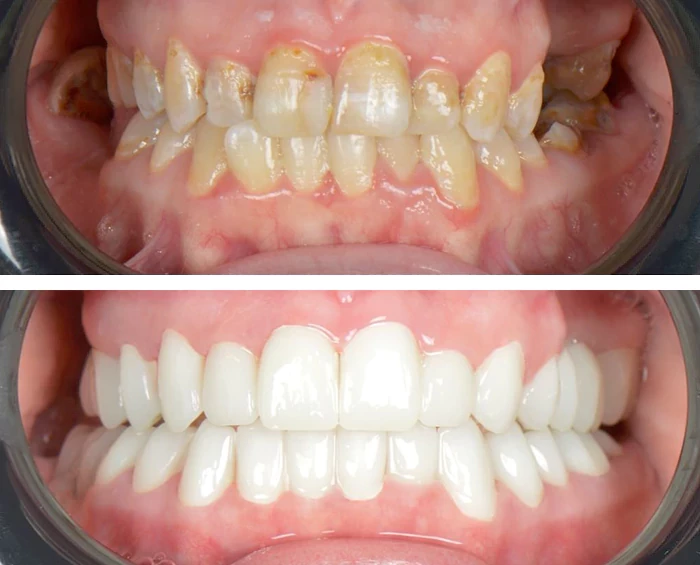 before & after photo of زراعة الأسنان