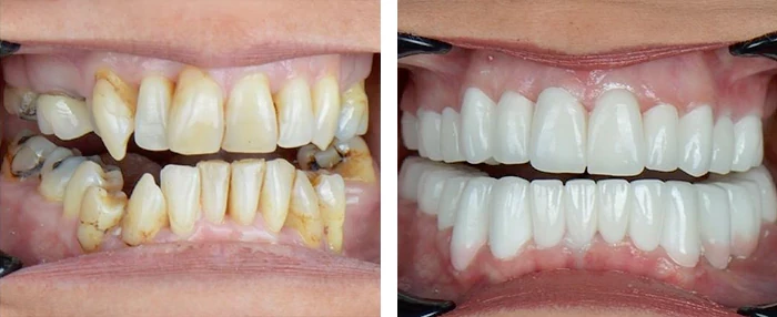 before & after photo of زراعة الأسنان