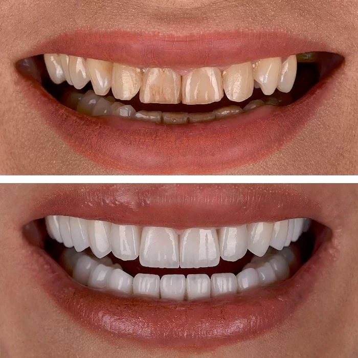 before & after photo of Dental Veneers