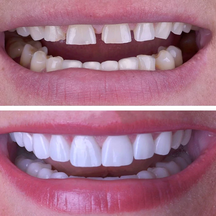 before & after photo of Dental Veneers