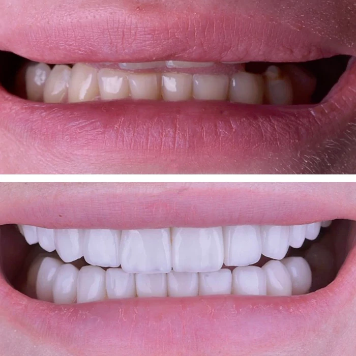 before & after photo of Dental Veneers