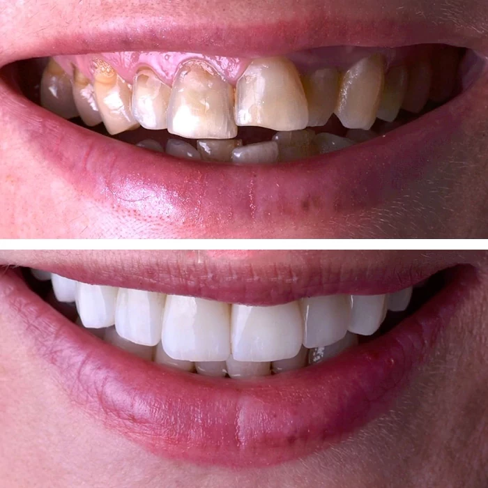 before & after photo of Dental Veneers