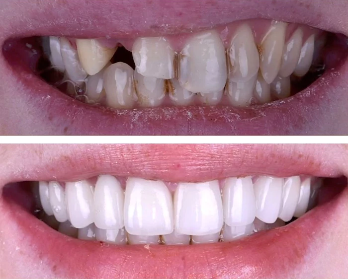 before & after photo of Dental Veneers