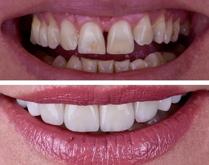 before & after photo of Dental Veneers