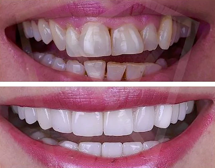 before & after photo of Dental Veneers