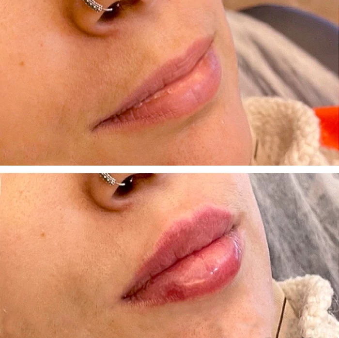 before & after photo of Lip Filler