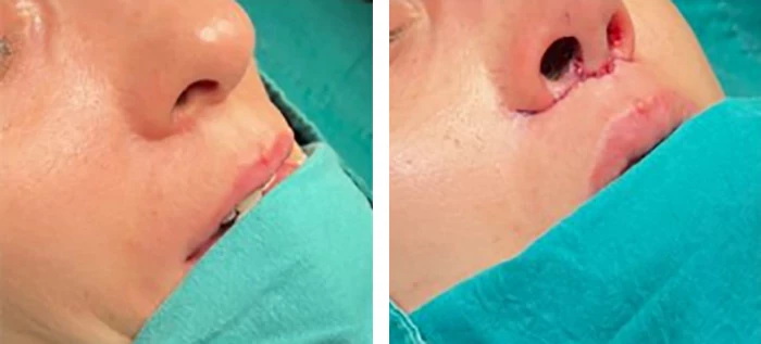 before & after photo of Lip Lift