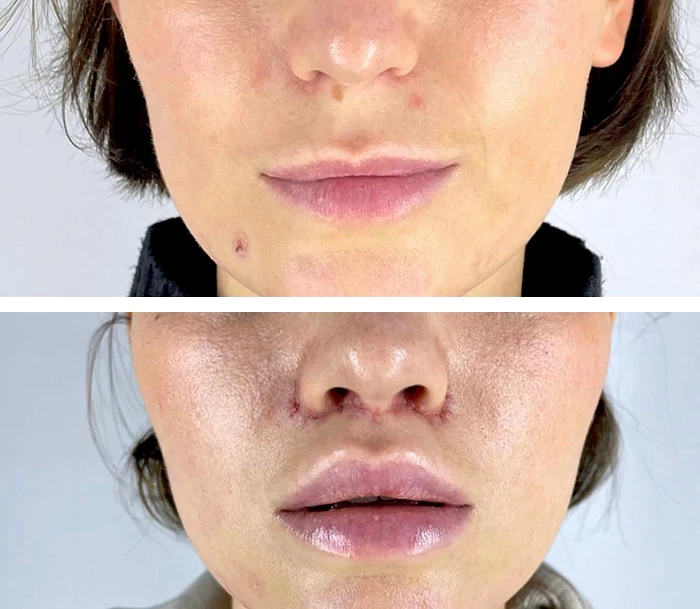 before & after photo of Lip Lift