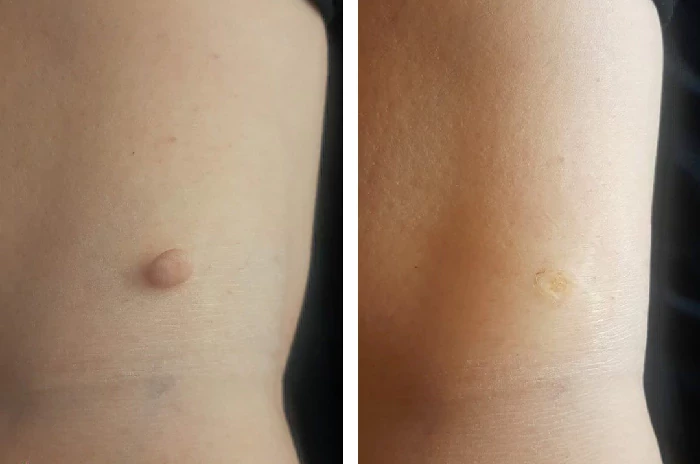 before & after photo of mole-removal-surgery