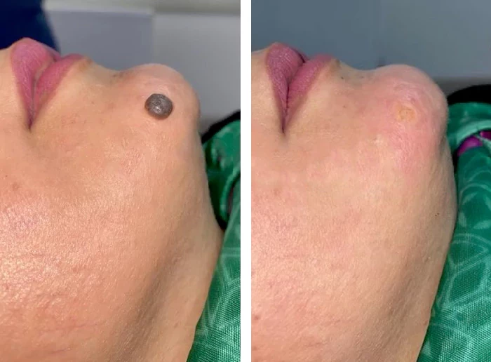 before & after photo of mole-removal-surgery