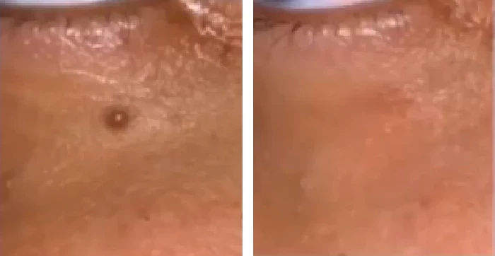 before & after photo of mole-removal-surgery