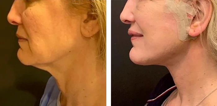 before & after photo of Neck Lift