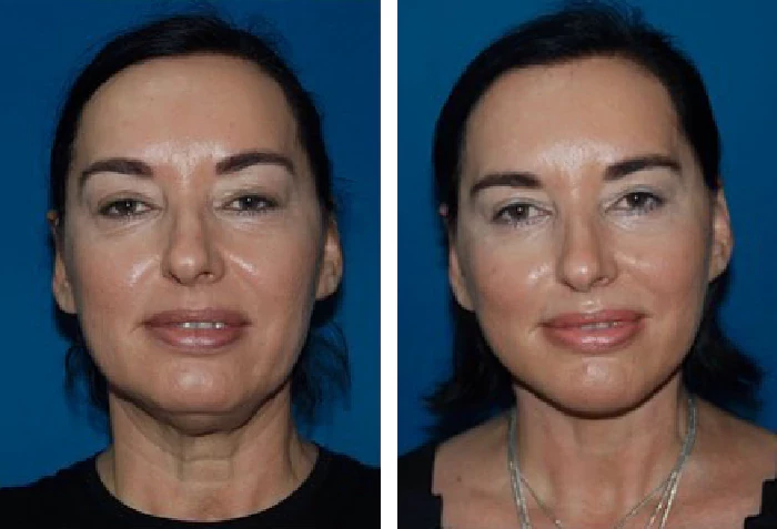 before & after photo of Neck Lift