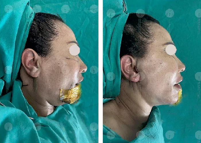 before & after photo of شد الرقبة