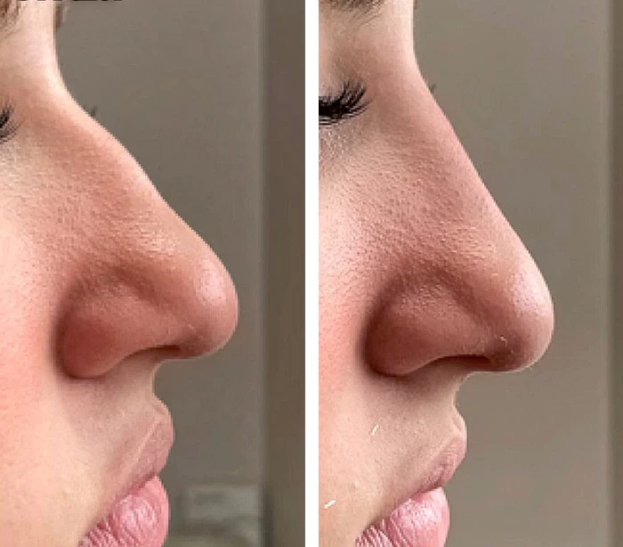 before & after photo of Nose Filler
