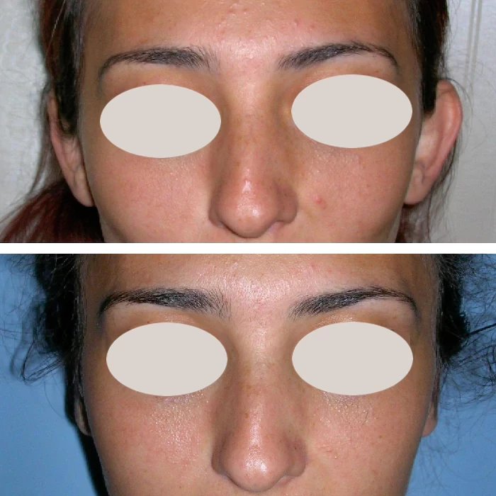 before & after photo of Otoplasty