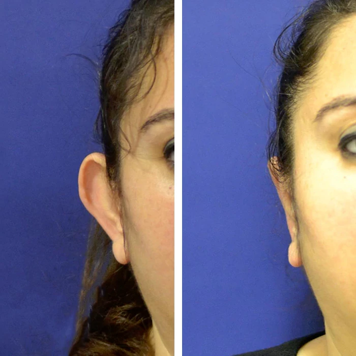 before & after photo of Otoplasty