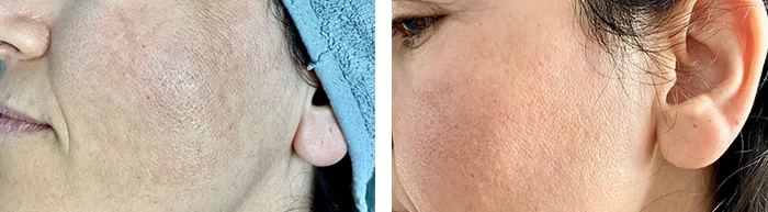 before & after photo of PRP Injection