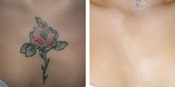 before & after photo of Laser Tattoo Removal