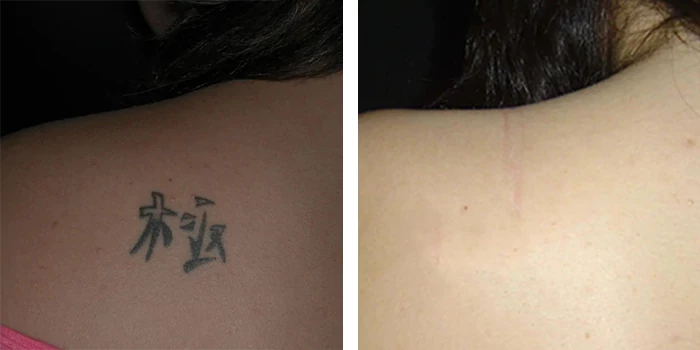 before & after photo of Laser Tattoo Removal