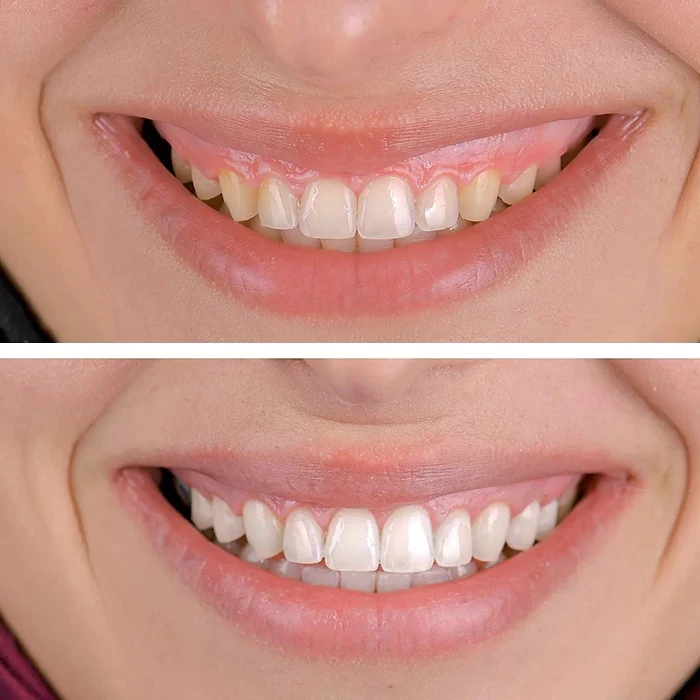 before & after photo of Teeth Whitening