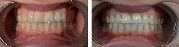 before & after photo of تبييض الأسنان