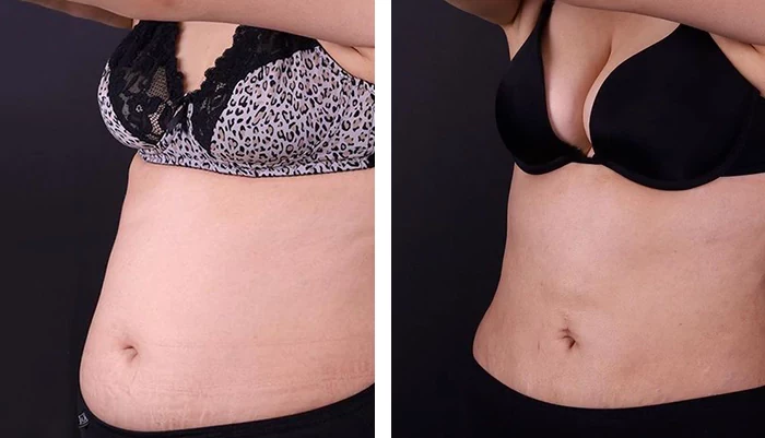 before & after photo of Liposuction