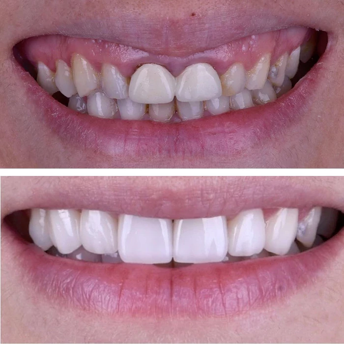 before & after photo of Dental Veneers