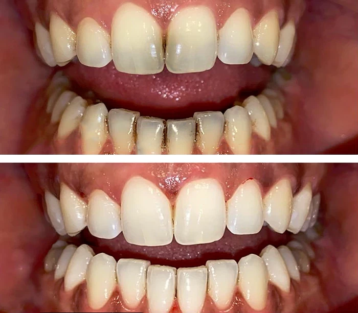 before & after photo of Teeth Whitening